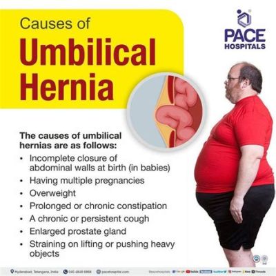 How to Lose Belly Fat with a Hernia